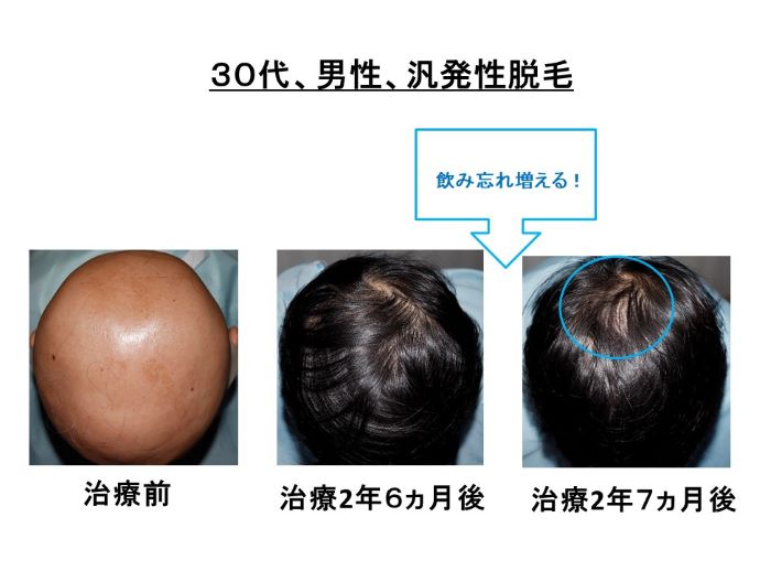 円形脱毛症　病院